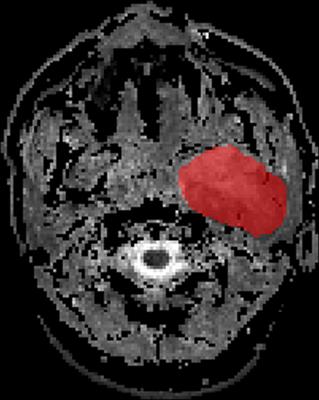 Apparent Diffusion Coefficient Map–Based Radiomics Features for Differential Diagnosis of Pleomorphic Adenomas and Warthin Tumors From Malignant Tumors